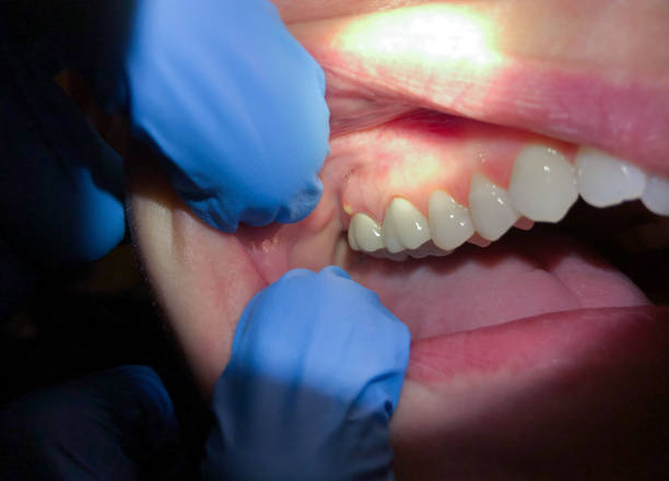 Best Knocked-Out Tooth (Avulsed Tooth) Treatment in Elk Rapids, MI