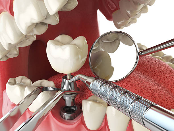 Best Emergency Denture Repair in Elk Rapids, MI